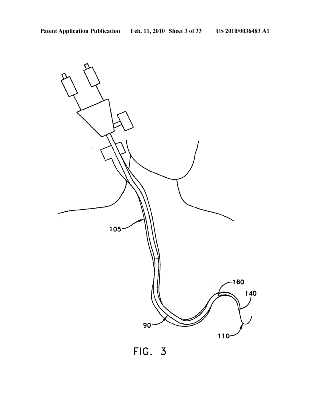 Method and apparatus for improving mitral valve function - diagram, schematic, and image 04