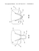 V-Shaped Staple for Spinal Prosthesis diagram and image