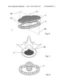 TOTAL DISC REPLACEMENT DEVICE diagram and image