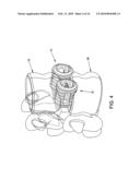 FUSION CAGE WITH REVERSE THREAD PROFILE (RTP) diagram and image