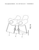 FUSION CAGE WITH REVERSE THREAD PROFILE (RTP) diagram and image