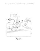 TRACHEOSTOMY TUBE COMBINATION RADIAL SNAP AND BAYONET CANNULA CONNECTOR diagram and image