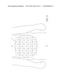 APPARATUS AND METHODS FOR THE DESTRUCTION OF ADIPOSE TISSUE diagram and image