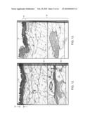 APPARATUS AND METHODS FOR THE DESTRUCTION OF ADIPOSE TISSUE diagram and image