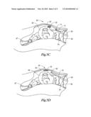 STERILE APPLIANCE DELIVERY DEVICE FOR ENDOSCOPIC PROCEDURES diagram and image