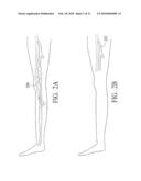 Endovenous Closure of Varicose Veins with Mid Infrared Laser diagram and image