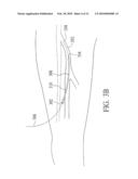 Endovenous Closure of Varicose Veins with Mid Infrared Laser diagram and image