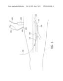 Endovenous Closure of Varicose Veins with Mid Infrared Laser diagram and image