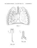 SELECTIVE LUNG TISSUE ABLATION diagram and image