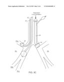 SELECTIVE LUNG TISSUE ABLATION diagram and image