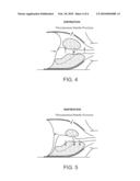 SELECTIVE LUNG TISSUE ABLATION diagram and image