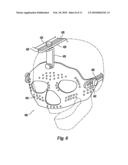 Craniofacial Fracture Reduction Assembly diagram and image