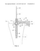 SYSTEMS AND METHODS FOR PROVIDING A BONE MILLING DEVICE diagram and image