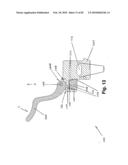 SURGICAL CABLE TENSIONING APPARATUS AND METHOD diagram and image