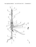 SURGICAL CABLE TENSIONING APPARATUS AND METHOD diagram and image