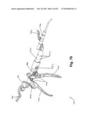 SURGICAL CABLE TENSIONING APPARATUS AND METHOD diagram and image