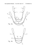 Nostril dilator diagram and image