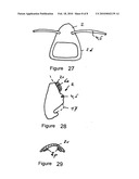 Device for reshaping bones diagram and image