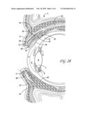 SURGICAL CORRECTION OF PTOSIS BY POLYMERIC ARTIFICIAL MUSCLES diagram and image