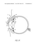 SURGICAL CORRECTION OF PTOSIS BY POLYMERIC ARTIFICIAL MUSCLES diagram and image