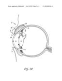 SURGICAL CORRECTION OF PTOSIS BY POLYMERIC ARTIFICIAL MUSCLES diagram and image