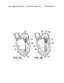 METHOD AND APPARATUS FOR REPAIRING OR REPLACING CHORDAE TENDINAE diagram and image