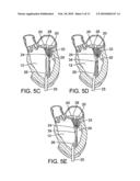 METHOD AND APPARATUS FOR REPAIRING OR REPLACING CHORDAE TENDINAE diagram and image