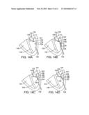 METHOD AND APPARATUS FOR REPAIRING OR REPLACING CHORDAE TENDINAE diagram and image