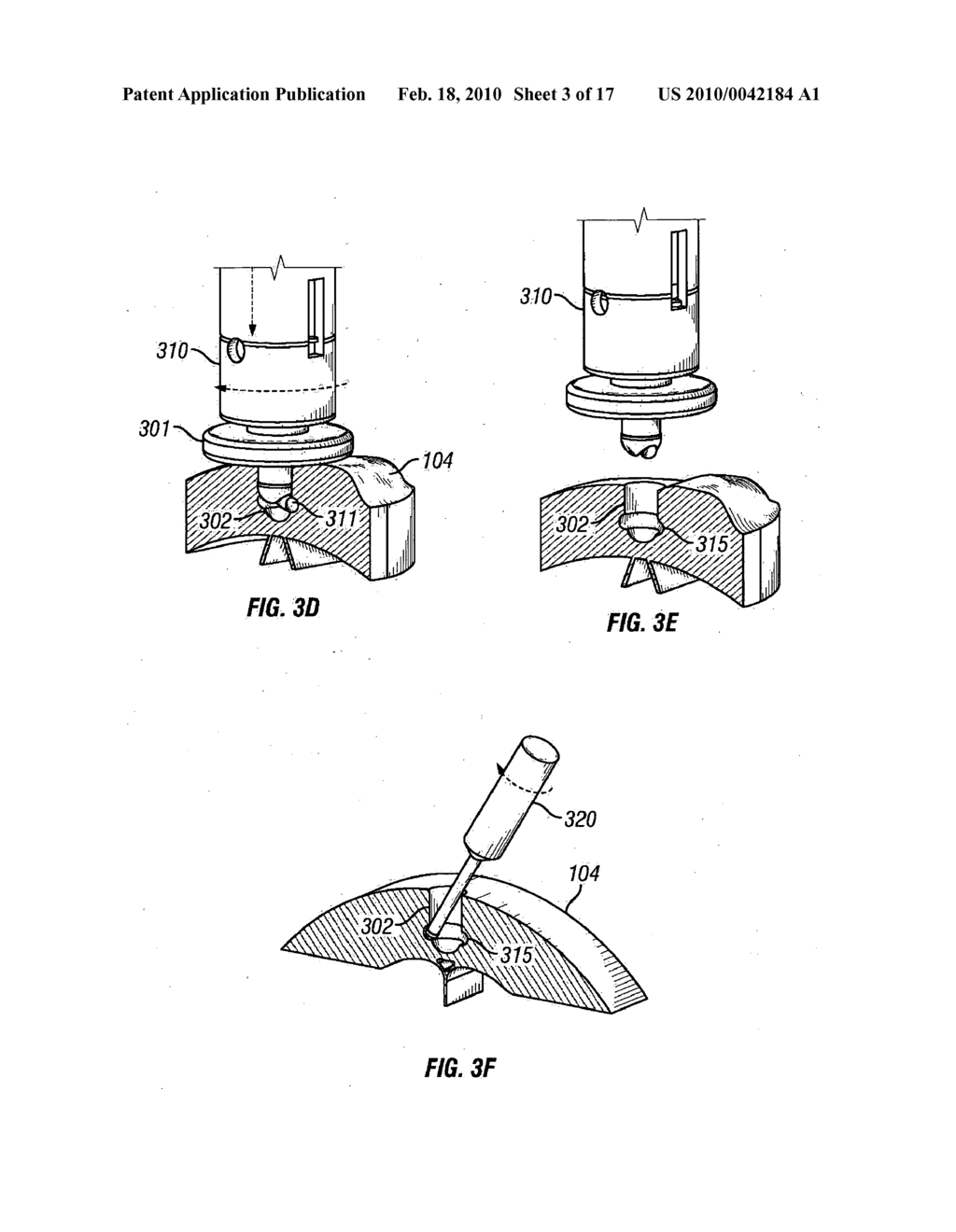 METHOD OF IMPLANTING A MEDICAL IMPLANT TO TREAT HEARING LOSS IN A PATIENT, DEVICES FOR FACILITING IMPLANTATION OF SUCH DEVICES, AND MEDICAL IMPLANTS FOR TREATING HEARING LOSS - diagram, schematic, and image 04