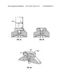 METHOD OF IMPLANTING A MEDICAL IMPLANT TO TREAT HEARING LOSS IN A PATIENT, DEVICES FOR FACILITING IMPLANTATION OF SUCH DEVICES, AND MEDICAL IMPLANTS FOR TREATING HEARING LOSS diagram and image