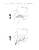 SOFT FILLED PROSTHESIS SHELL WITH DISCRETE FIXATION SURFACES diagram and image