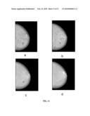 Method for Mass Candidate Detection and Segmentation in Digital Mammograms diagram and image