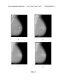 Method for Mass Candidate Detection and Segmentation in Digital Mammograms diagram and image