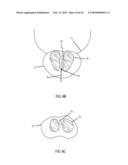 Non-Thermal Ablation System for Treating BPH and Other Growths diagram and image