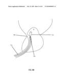 Non-Thermal Ablation System for Treating BPH and Other Growths diagram and image