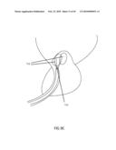 Non-Thermal Ablation System for Treating BPH and Other Growths diagram and image