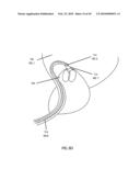 Non-Thermal Ablation System for Treating BPH and Other Growths diagram and image