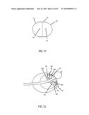 Non-Thermal Ablation System for Treating BPH and Other Growths diagram and image