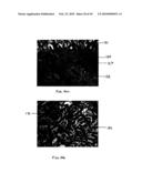 Non-Thermal Ablation System for Treating BPH and Other Growths diagram and image