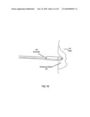 Non-Thermal Ablation System for Treating BPH and Other Growths diagram and image