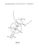 Non-Thermal Ablation System for Treating BPH and Other Growths diagram and image