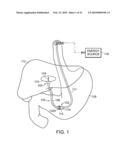 ELECTRICAL ABLATION DEVICES diagram and image