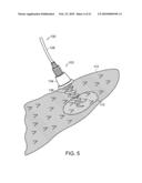 ELECTRICAL ABLATION DEVICES diagram and image