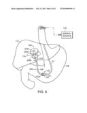 ELECTRICAL ABLATION DEVICES diagram and image