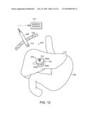 ELECTRICAL ABLATION DEVICES diagram and image