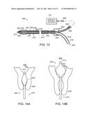 ELECTRICAL ABLATION DEVICES diagram and image