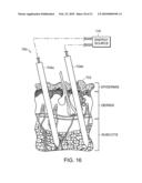 ELECTRICAL ABLATION DEVICES diagram and image