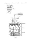 ELECTRICAL ABLATION DEVICES diagram and image