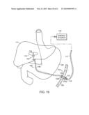 ELECTRICAL ABLATION DEVICES diagram and image