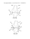 ARTHROPLASTY SYSTEM AND RELATED METHODS diagram and image